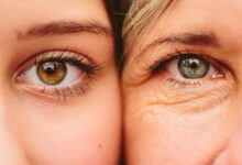 Facts About Upper and Lower Eyelid Surgery in New York City, NY