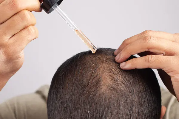 Hair Loss Solutions: What You Need to Know About Treatment Options Hair Loss Solutions: What You Need to Know About Treatment Options