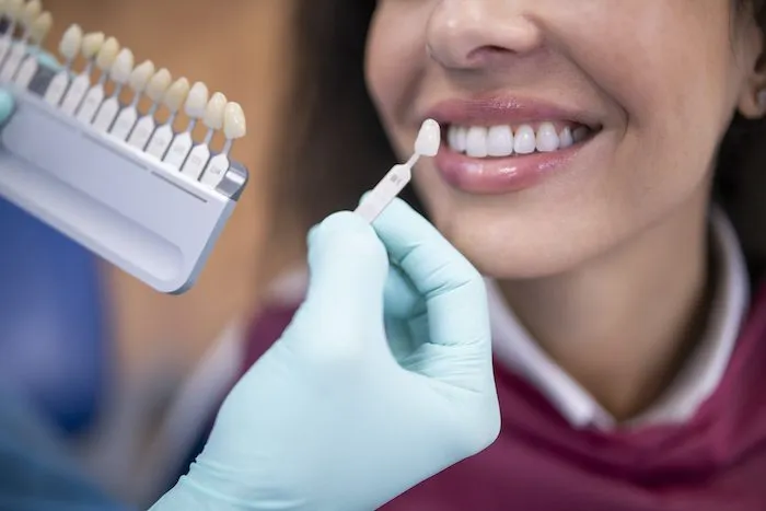 How Veneers Have Evolved How Veneers Have Evolved