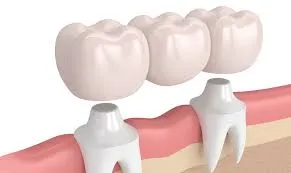 How Crowns Can Save Your Teeth from Further Damage