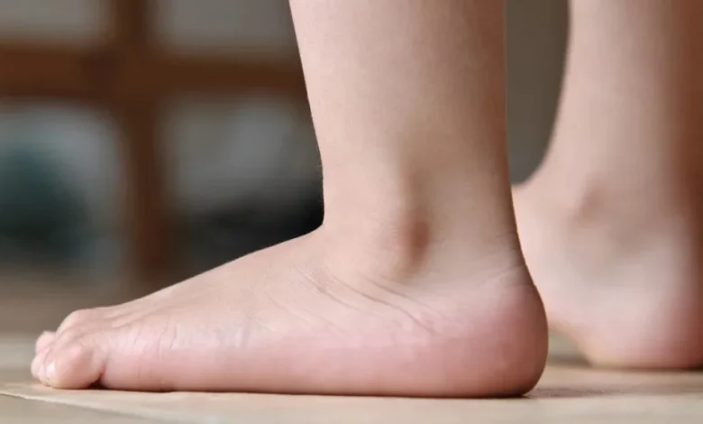 How to Treat Flat Feet in Children and Adults