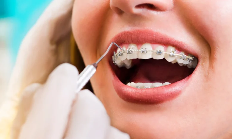 Orthodontic Options for Adults Orthodontic Options for Adults