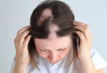 Alopecia