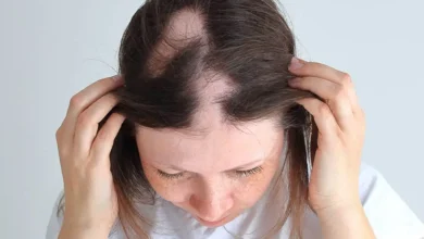 Alopecia