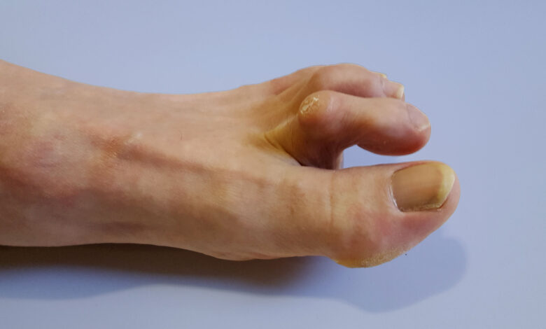 The Impact of Hammer Toe on Your Daily Life and How to Manage It Hammer Toe
