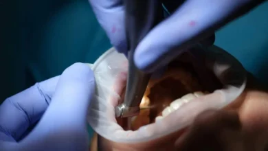 The Role of Dental Crowns in Restorative Dentistry 