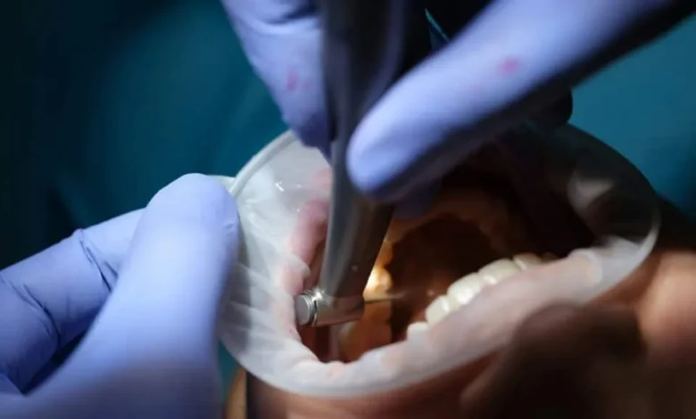 The Role of Dental Crowns in Restorative Dentistry 