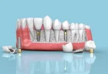 The Lifespan of Dental Implants What You Should Know