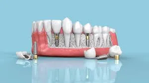 The Lifespan of Dental Implants What You Should Know