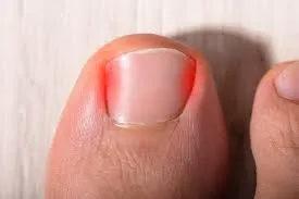 The Connection Between Toenail Fungus and Ingrown Toenails