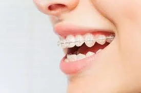How Invisalign Works to Straighten Teeth Comfortably and Effectively How Invisalign Works to Straighten Teeth Comfortably and Effectively