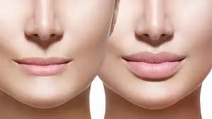 Can Lip Fillers Reduce Wrinkles? Can Lip Fillers Reduce Wrinkles?