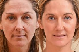 How Do Laser Skin Treatments Work? Laser Skin Treatments