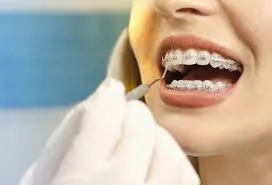 Adult Braces What You Need to Know