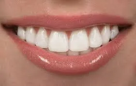 How Veneers Can Improve More Than Just Your Smile