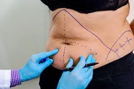 Types of Liposuction Treatments