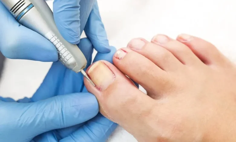 The Hidden Causes of Ingrown Toenails and How to Prevent Them