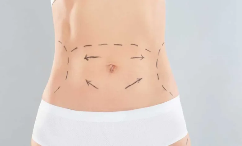 The Role of a Tummy Tuck in Restoring Abdominal Tone Tummy Tuck