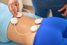 Spinal Cord Stimulation